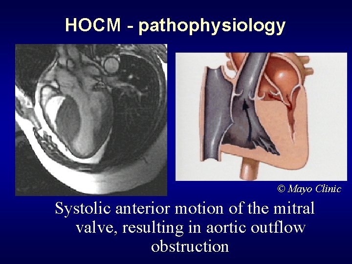 HOCM - pathophysiology © Mayo Clinic Systolic anterior motion of the mitral valve, resulting