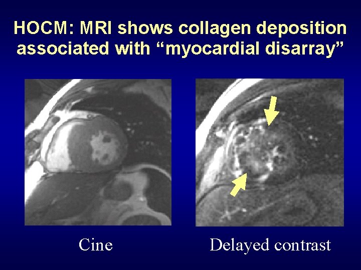 HOCM: MRI shows collagen deposition associated with “myocardial disarray” Cine Delayed contrast 