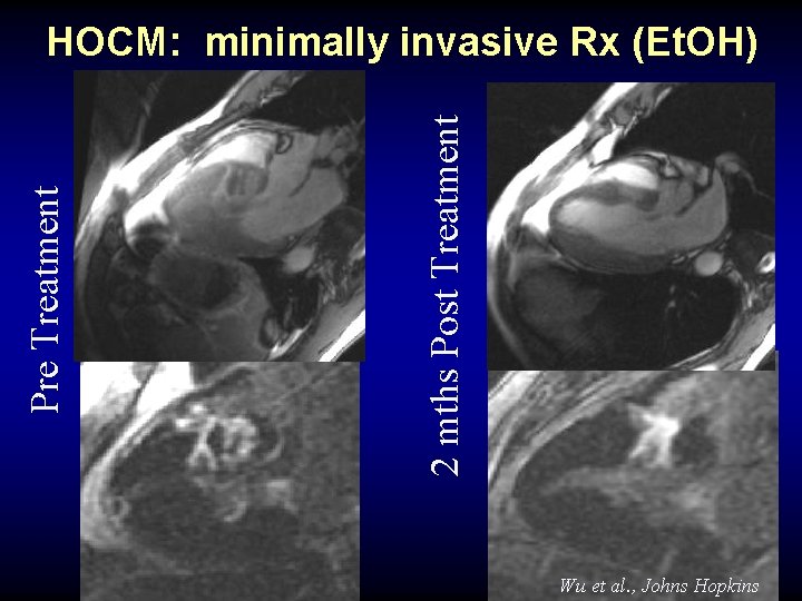 2 mths Post Treatment Pre Treatment HOCM: minimally invasive Rx (Et. OH) Wu et