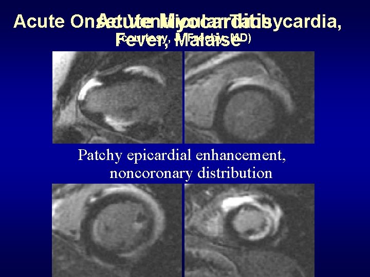 Acute Onset Ventricular Tachycardia, Acute Myocarditis (courtesy, Malaise J. Freeby, MD) Fever, Patchy epicardial