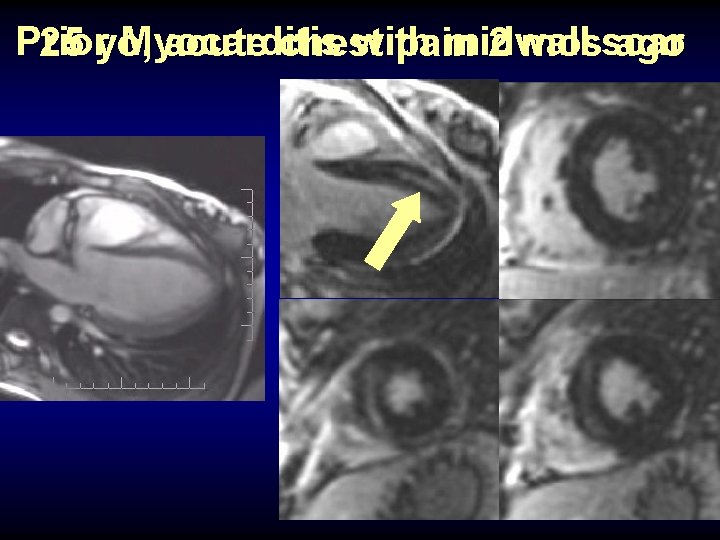 Prior Myocarditis with midwall 25 yo, acute chest pain 2 mosscar ago 