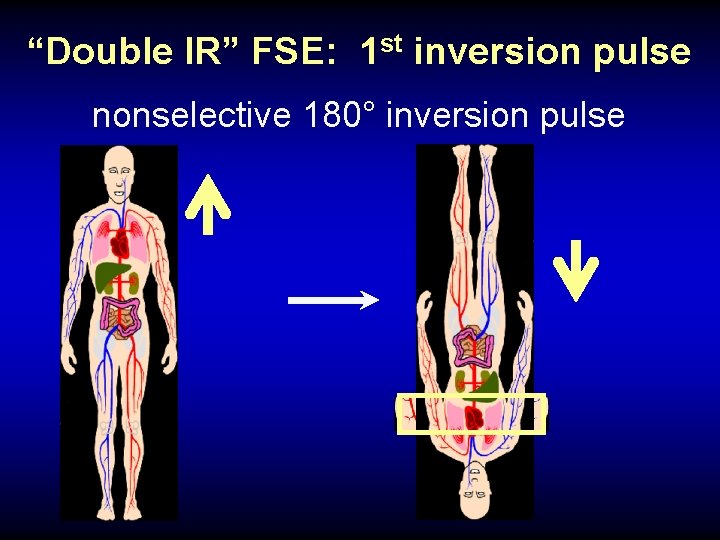 “Double IR” FSE: 1 st inversion pulse nonselective 180° inversion pulse 