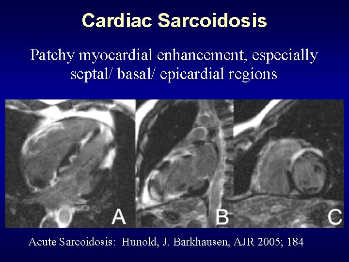 Cardiac Sarcoidosis Patchy myocardial enhancement, especially septal/ basal/ epicardial regions Acute Sarcoidosis: Hunold, J.