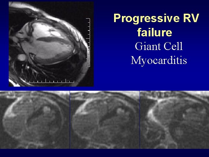 Progressive RV failure Giant Cell Myocarditis 