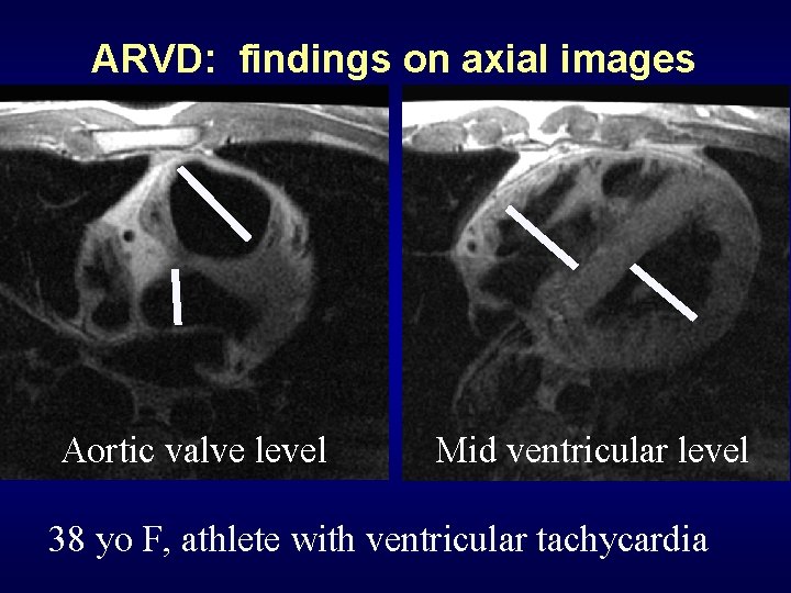 ARVD: findings on axial images Aortic valve level Mid ventricular level 38 yo F,