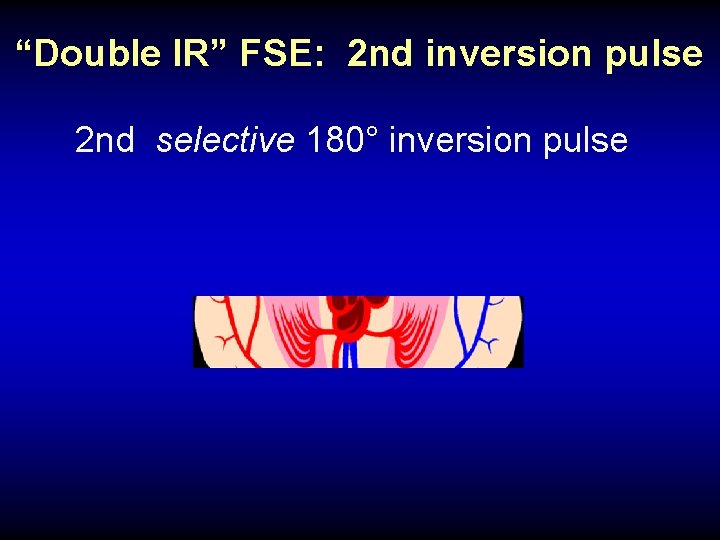 “Double IR” FSE: 2 nd inversion pulse 2 nd selective 180° inversion pulse 