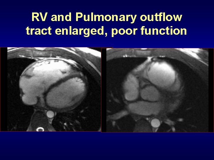 RV and Pulmonary outflow tract enlarged, poor function 