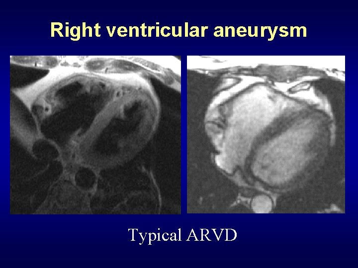 Right ventricular aneurysm Typical ARVD 
