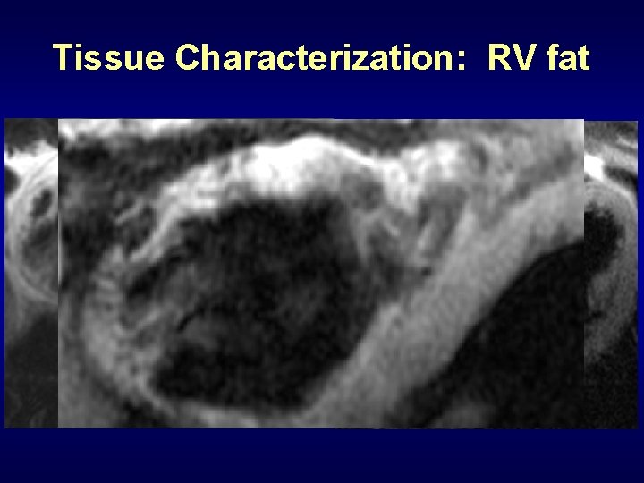 Tissue Characterization: RV fat 