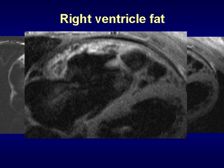 Right ventricle fat 