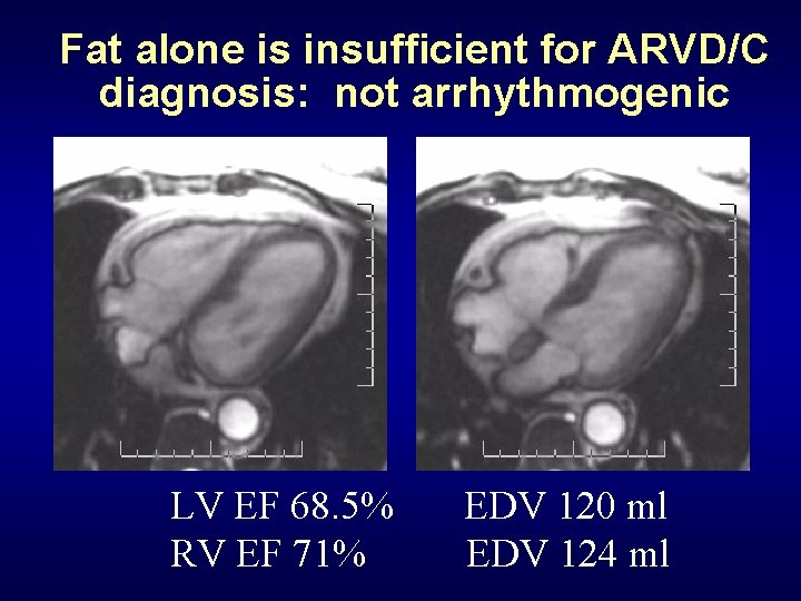 Fat alone is insufficient for ARVD/C diagnosis: not arrhythmogenic LV EF 68. 5% RV