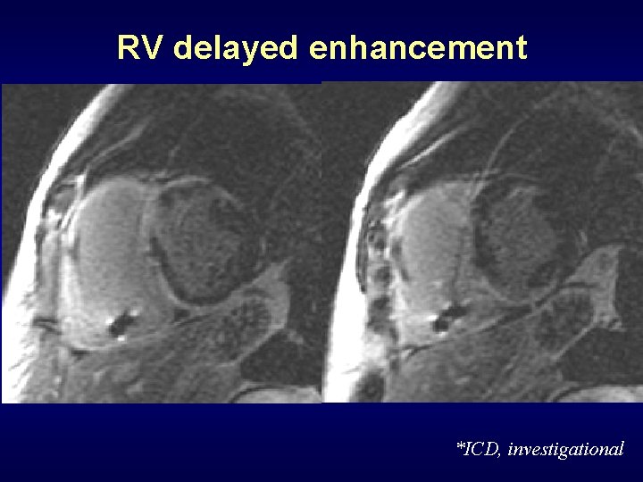 RV delayed enhancement *ICD, investigational 