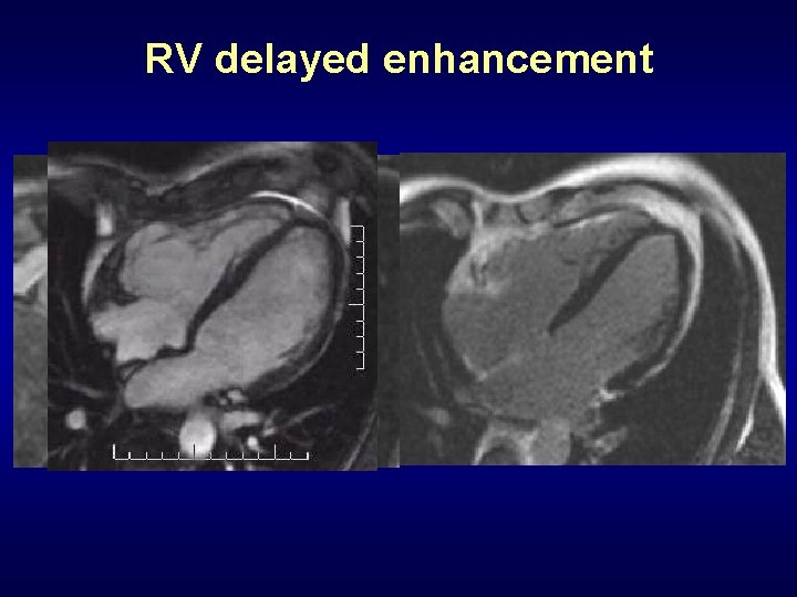 RV delayed enhancement 