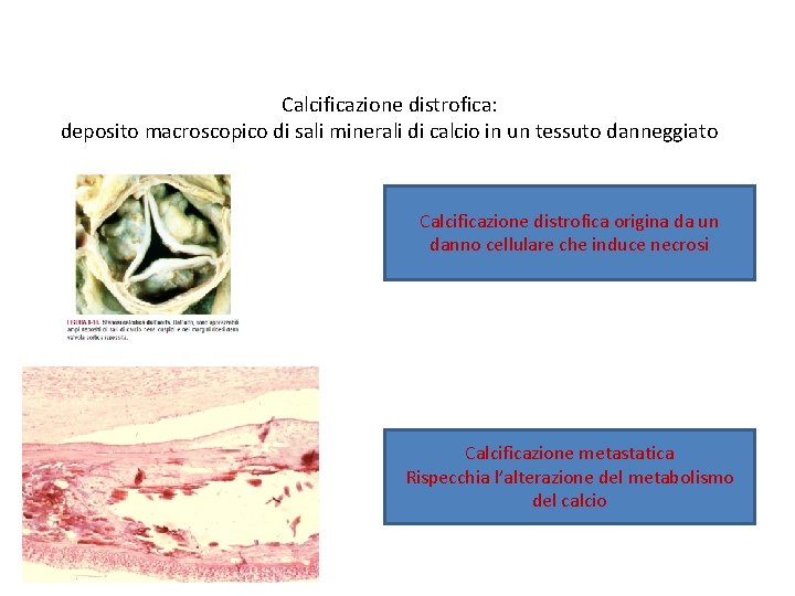 Calcificazione distrofica: deposito macroscopico di sali minerali di calcio in un tessuto danneggiato Calcificazione