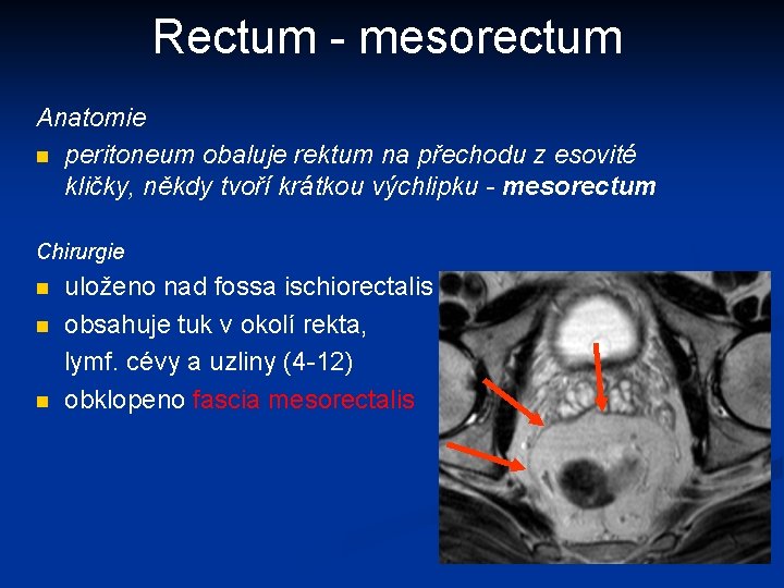 Rectum - mesorectum Anatomie n peritoneum obaluje rektum na přechodu z esovité kličky, někdy