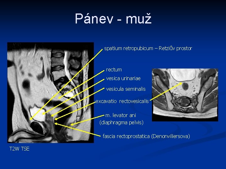 Pánev - muž spatium retropubicum – Retziův prostor rectum vesica urinariae vesicula seminalis excavatio