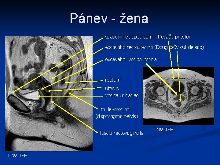 Pánev - žena spatium retropubicum – Retziův prostor excavatio rectouterina (Douglasův cul-de sac) excavatio
