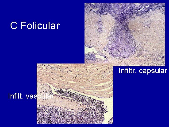 C Folicular Infiltr. capsular Infilt. vascular 