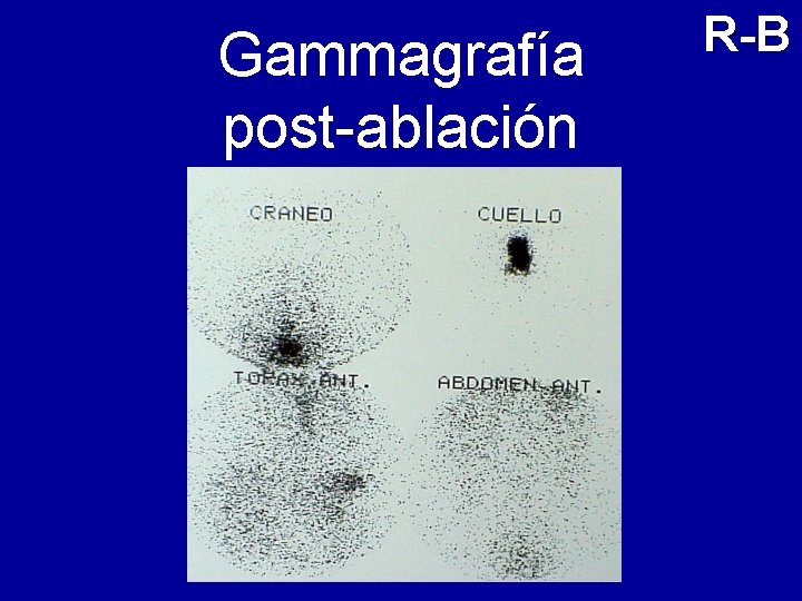 Gammagrafía post-ablación R-B 