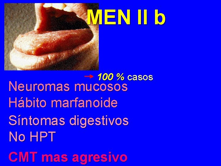 MEN II b 100 % casos Neuromas mucosos Hábito marfanoide Síntomas digestivos No HPT