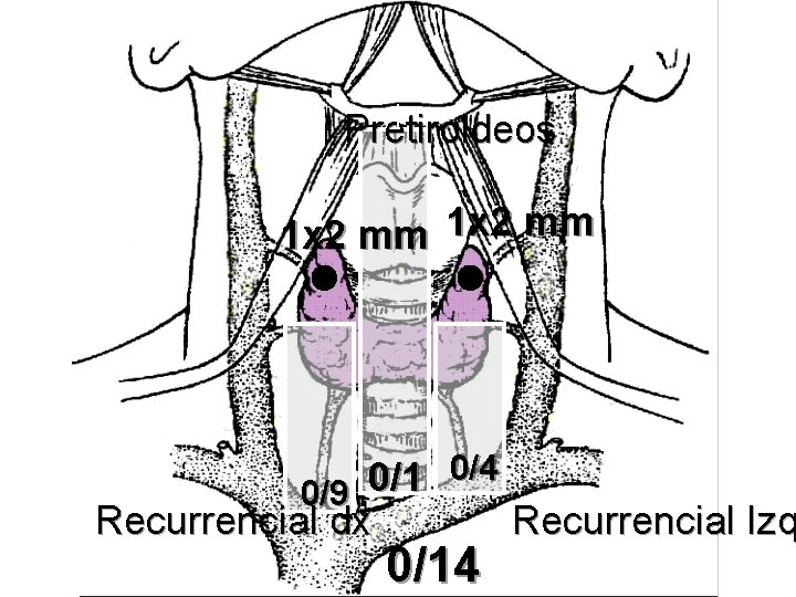 Pretiroideos 1 x 2 mm 0/4 0/1 0/9 Recurrencial dx Recurrencial Izq 0/14 