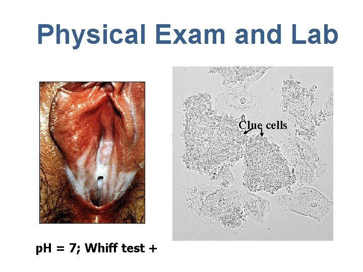 Physical Exam and Lab Clue cells p. H = 7; Whiff test + 