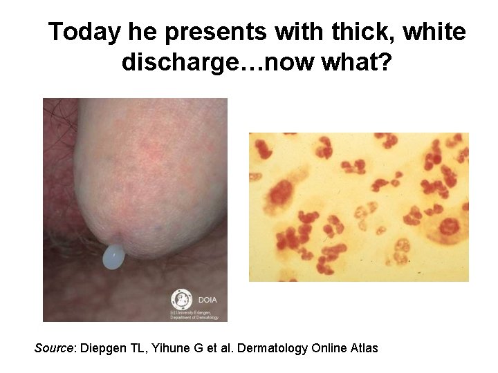 Today he presents with thick, white discharge…now what? Source: Diepgen TL, Yihune G et