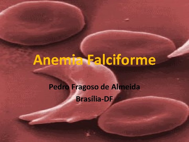 Anemia Falciforme Pedro Fragoso de Almeida Brasília-DF 