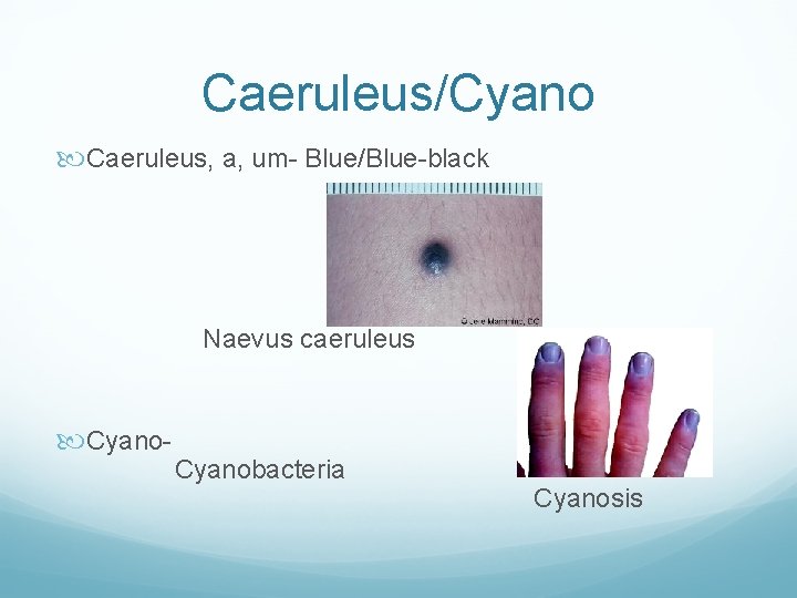 Caeruleus/Cyano Caeruleus, a, um- Blue/Blue-black Naevus caeruleus Cyano- Cyanobacteria Cyanosis 