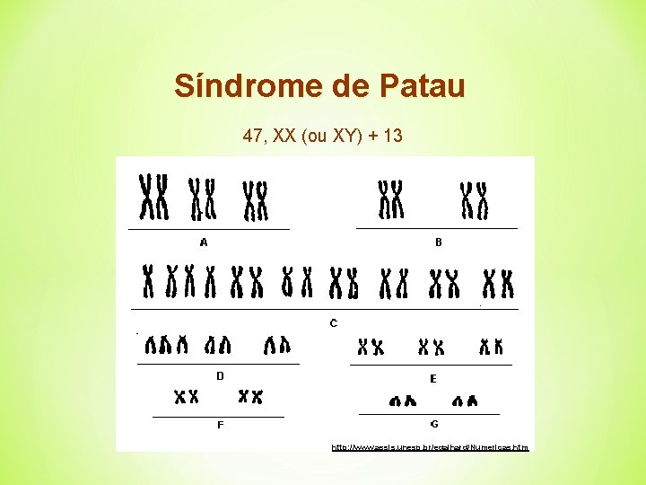 Síndrome de Patau 47, XX (ou XY) + 13 http: //www. assis. unesp. br/egalhard/Numericas.