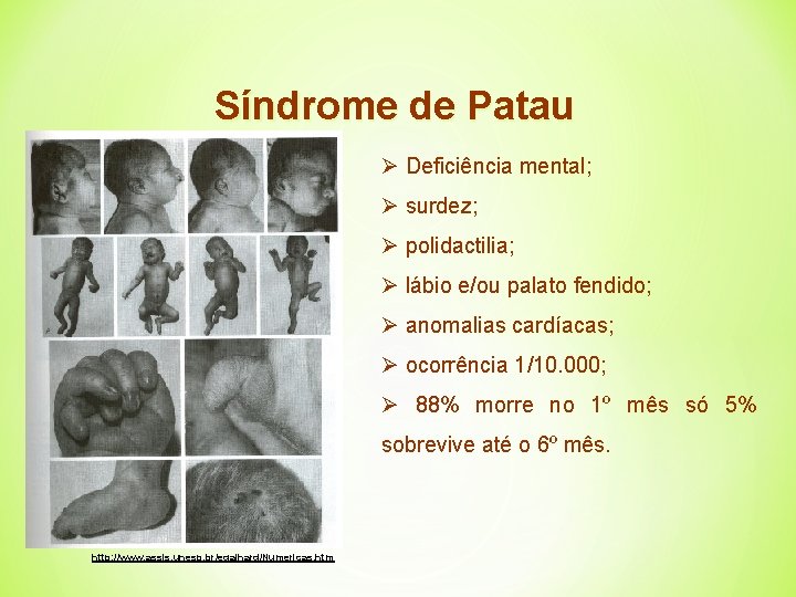 Síndrome de Patau Ø Deficiência mental; Ø surdez; Ø polidactilia; Ø lábio e/ou palato