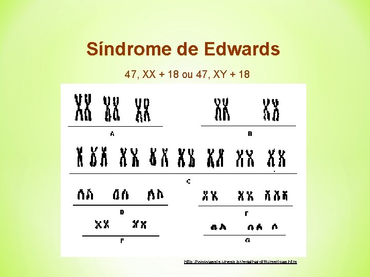 Síndrome de Edwards 47, XX + 18 ou 47, XY + 18 http: //www.