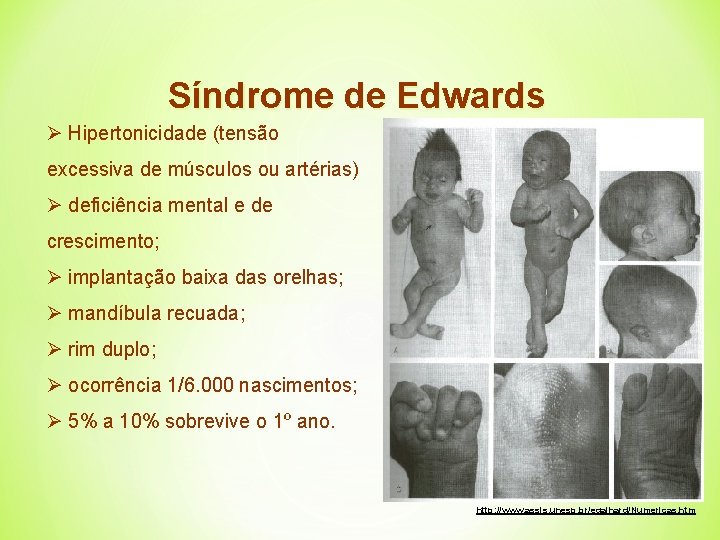 Síndrome de Edwards Ø Hipertonicidade (tensão excessiva de músculos ou artérias) Ø deficiência mental