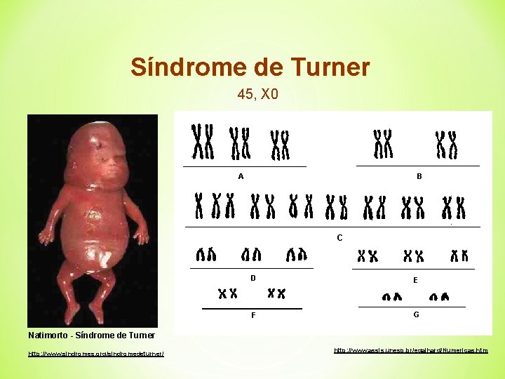 Síndrome de Turner 45, X 0 Natimorto - Síndrome de Turner http: //www. sindromes.