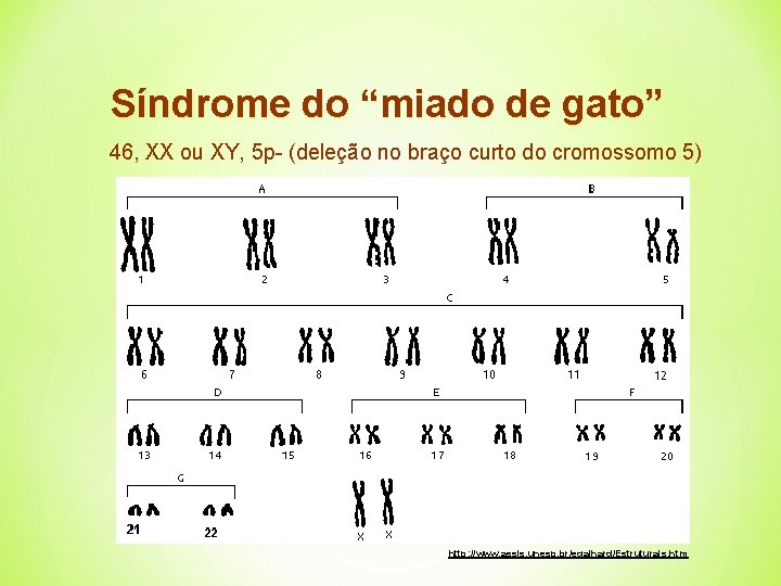 Síndrome do “miado de gato” 46, XX ou XY, 5 p- (deleção no braço