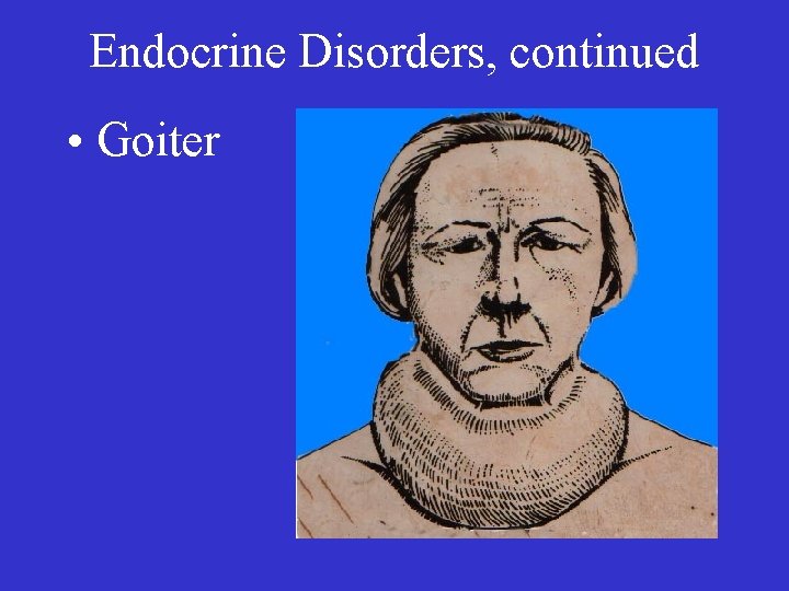 Endocrine Disorders, continued • Goiter 