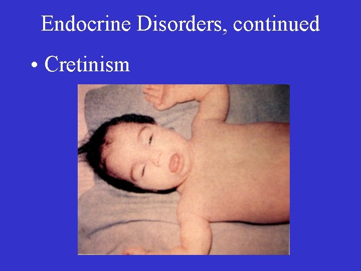 Endocrine Disorders, continued • Cretinism 