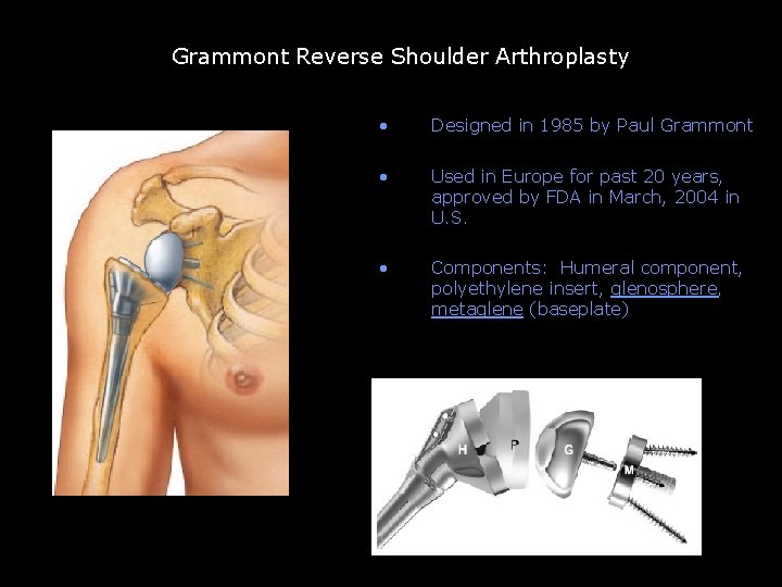 Grammont reverse TSA Grammont Reverse Shoulder Arthroplasty • Designed in 1985 by Paul Grammont