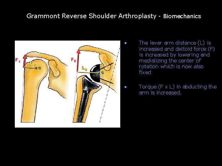 Grammont reverse TSA Grammont Reverse Shoulder Arthroplasty - Biomechanics • The lever arm distance Grammont reverse TSA Grammont Reverse Shoulder Arthroplasty - Biomechanics • The lever arm distance