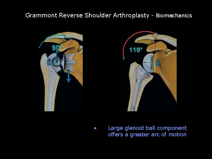 Grammont reverse TSA Grammont Reverse Shoulder Arthroplasty - Biomechanics • Large glenoid ball component