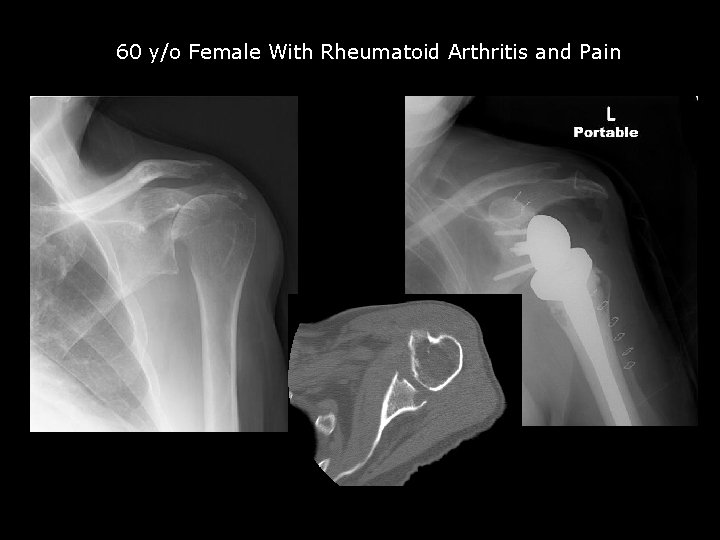 60 y/o Female With Rheumatoid Arthritis and Pain 