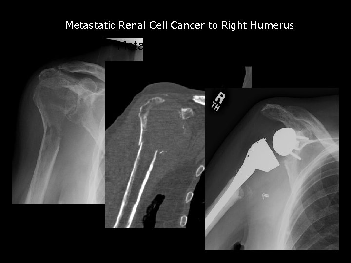 Metastatic Renal Cell Cancer to Right Humerus Metastatic renal cell 