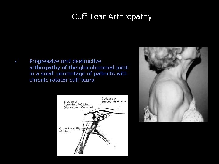 Cuff Tear Arthropathy -- • Progressive and destructive arthropathy of the glenohumeral joint in Cuff Tear Arthropathy -- • Progressive and destructive arthropathy of the glenohumeral joint in