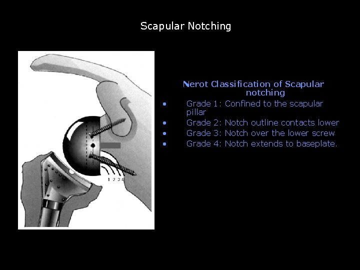 Scapular Notching • • Nerot Classification of Scapular notching Grade 1: Confined to the