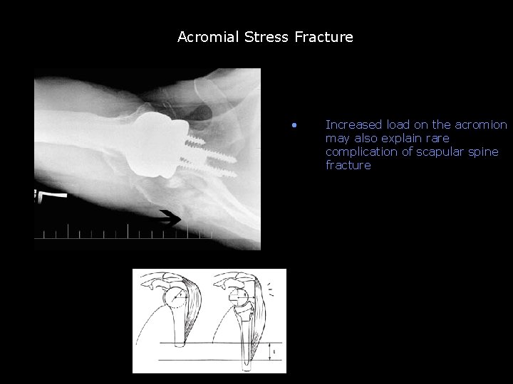 Acromial Stress Fracture • Increased load on the acromion may also explain rare complication Acromial Stress Fracture • Increased load on the acromion may also explain rare complication