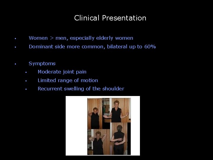 Clinical Presentation -- • Women > men, especially elderly women • Dominant side more