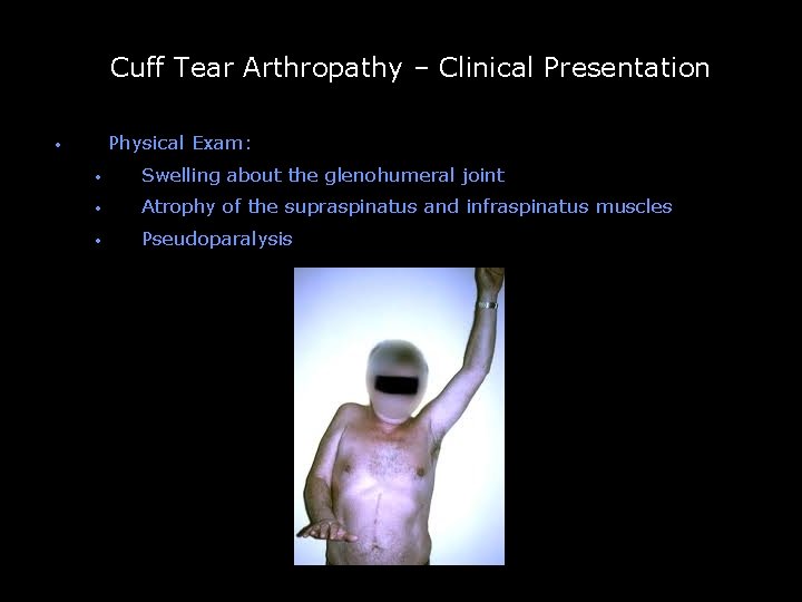 Cuff Tear Arthropathy – Clinical Presentation Physical Exam: • -- • Swelling about the