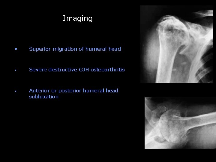 Imaging -- • Superior migration of humeral head • Severe destructive GJH osteoarthritis •