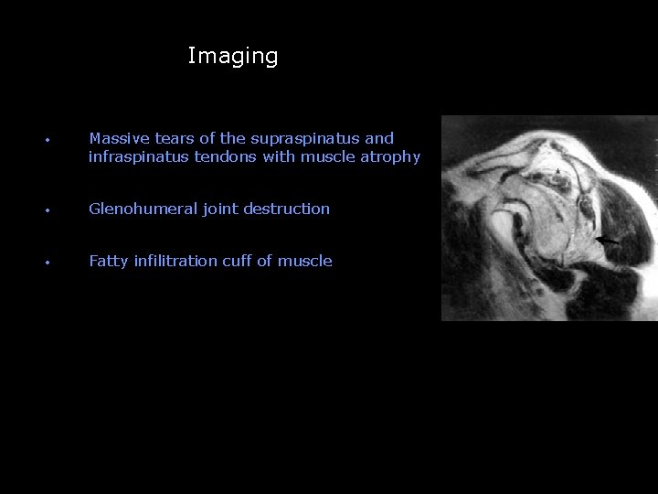 Imaging -- • Massive tears of the supraspinatus and infraspinatus tendons with muscle atrophy