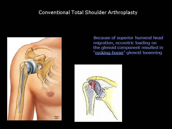 Conventional Total Shoulder Arthroplasty Conventional TSA not satisfactory Because of superior humeral head migration, Conventional Total Shoulder Arthroplasty Conventional TSA not satisfactory Because of superior humeral head migration,